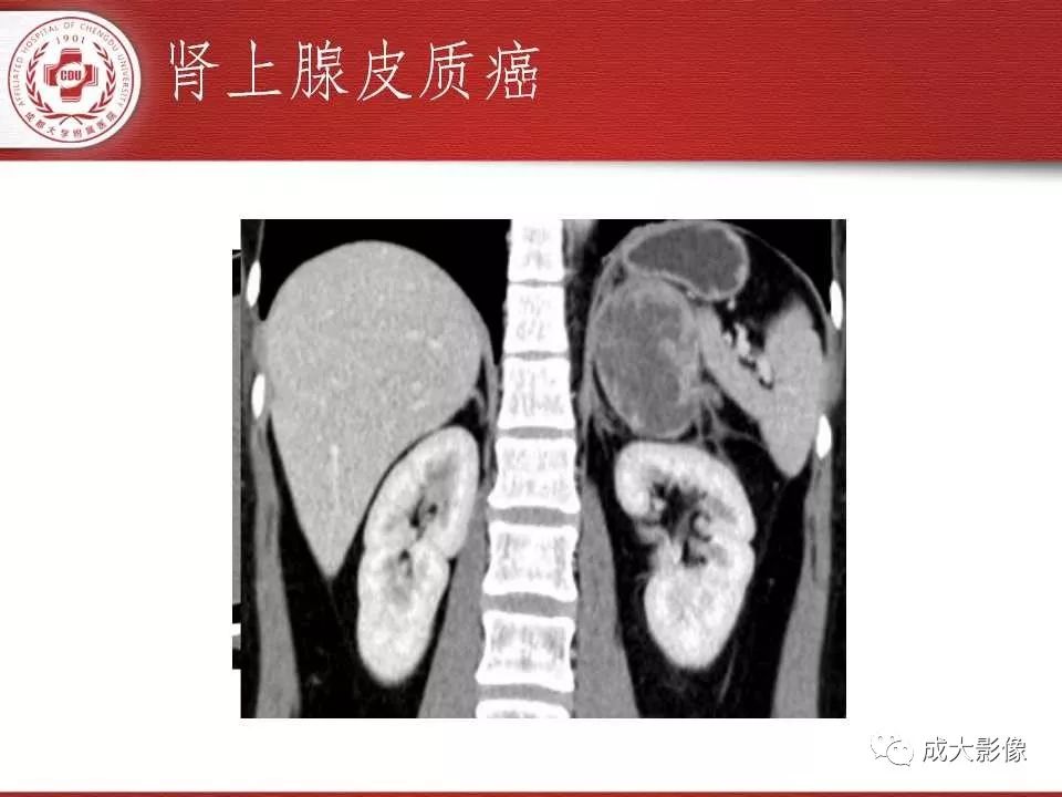 影像PPT - 【PPT】常见肾上腺疾病影像诊断-26