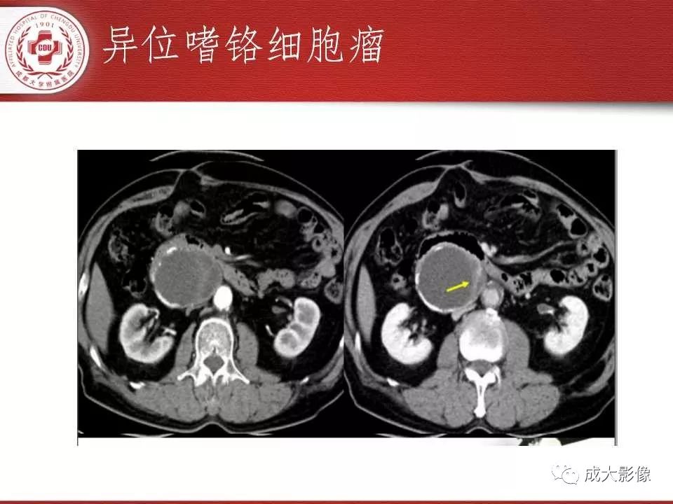 影像PPT - 【PPT】常见肾上腺疾病影像诊断-33