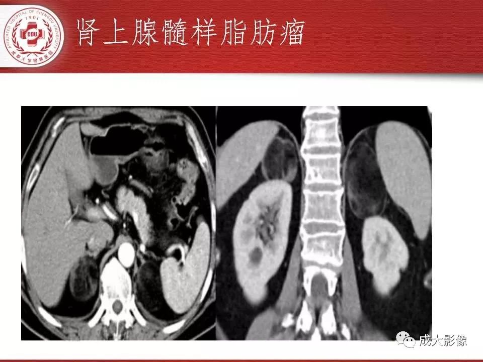 影像PPT - 【PPT】常见肾上腺疾病影像诊断-39