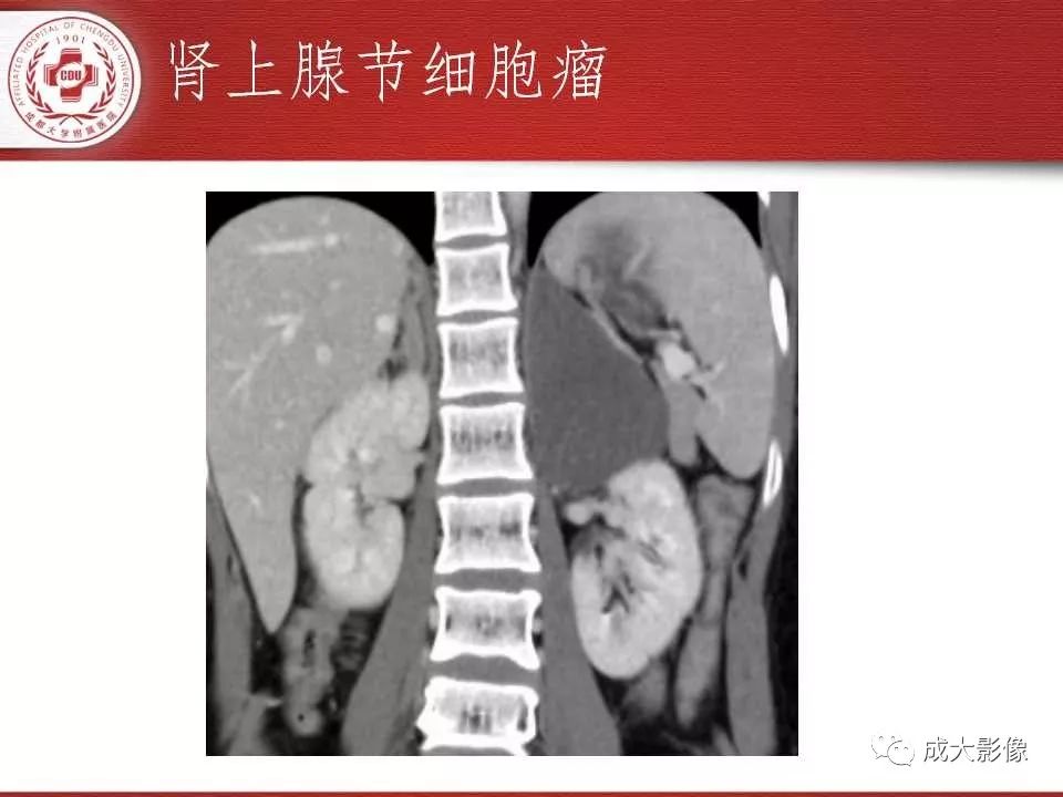影像PPT - 【PPT】常见肾上腺疾病影像诊断-35