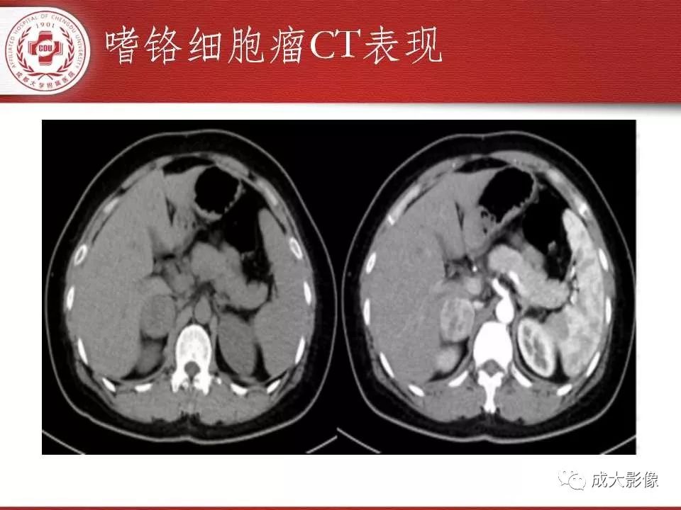 影像PPT - 【PPT】常见肾上腺疾病影像诊断-32