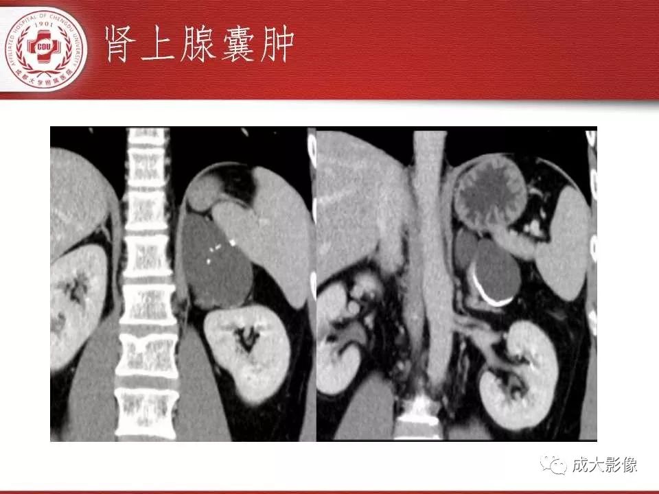 影像PPT - 【PPT】常见肾上腺疾病影像诊断-45