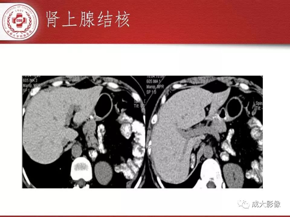 影像PPT - 【PPT】常见肾上腺疾病影像诊断-47