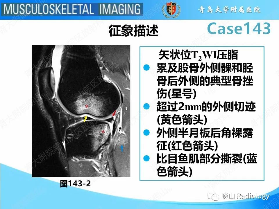 影像PPT - 【PPT】外侧深切迹征（前交叉韧带撕裂）-16