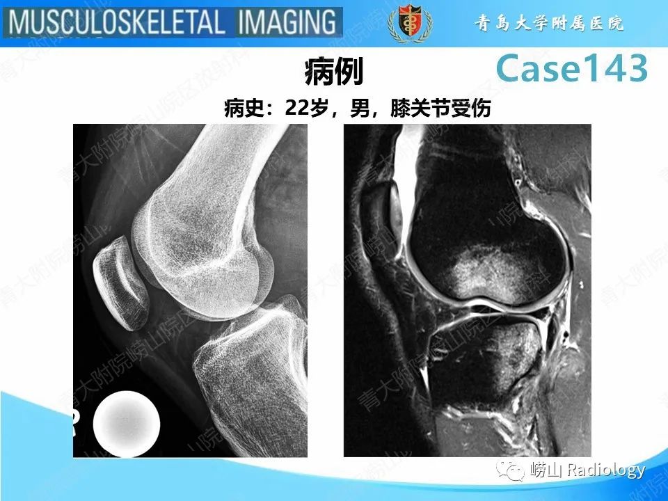 影像PPT - 【PPT】外侧深切迹征（前交叉韧带撕裂）-2
