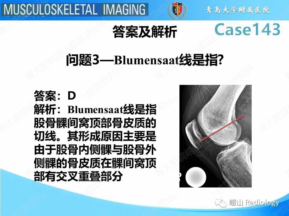 影像PPT - 【PPT】外侧深切迹征（前交叉韧带撕裂）-8