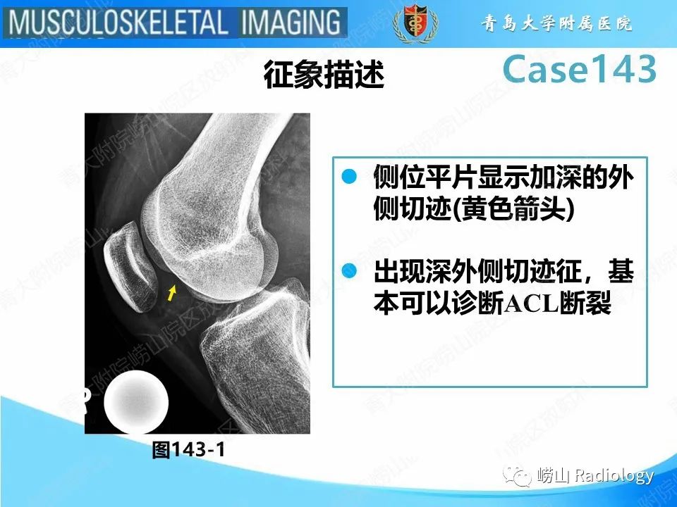 影像PPT - 【PPT】外侧深切迹征（前交叉韧带撕裂）-15
