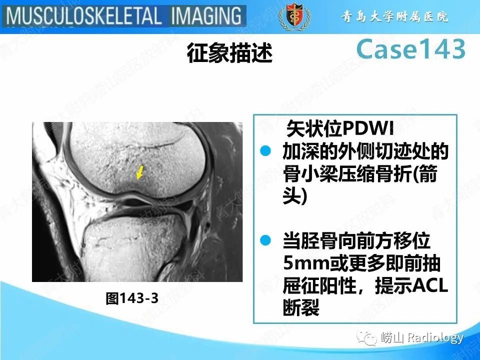 影像PPT - 【PPT】外侧深切迹征（前交叉韧带撕裂）-18
