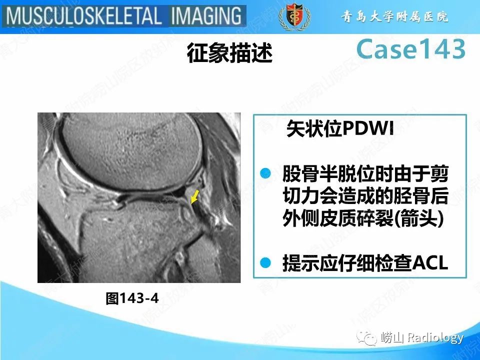 影像PPT - 【PPT】外侧深切迹征（前交叉韧带撕裂）-19