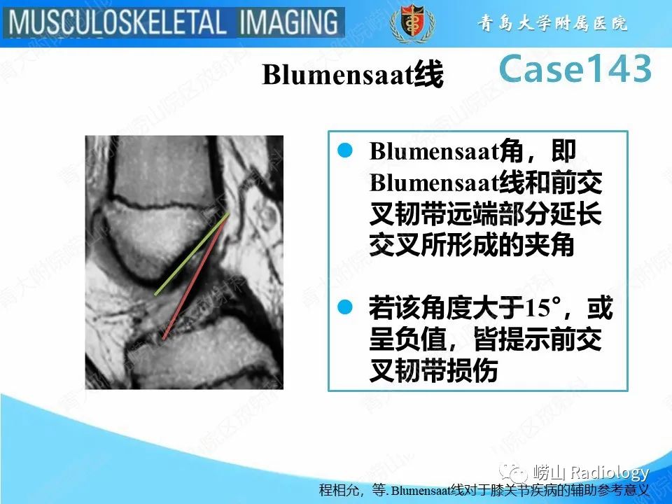 影像PPT - 【PPT】外侧深切迹征（前交叉韧带撕裂）-9