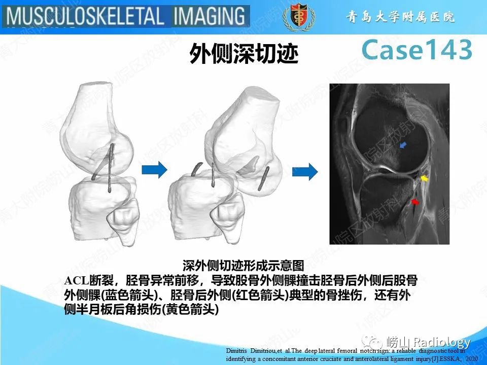 影像PPT - 【PPT】外侧深切迹征（前交叉韧带撕裂）-13