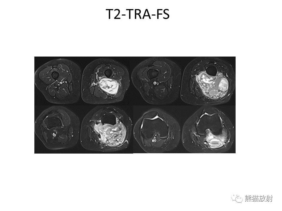 影像PPT - 【病例】腱鞘巨细胞瘤2例MR影像-13