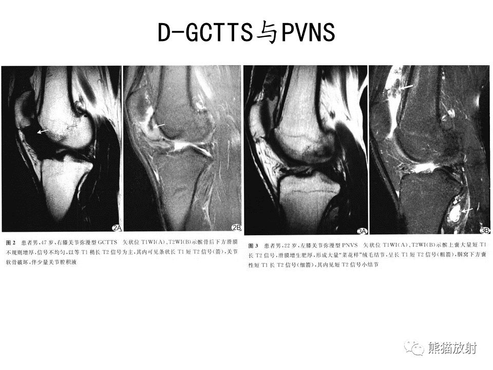 影像PPT - 【病例】腱鞘巨细胞瘤2例MR影像-27