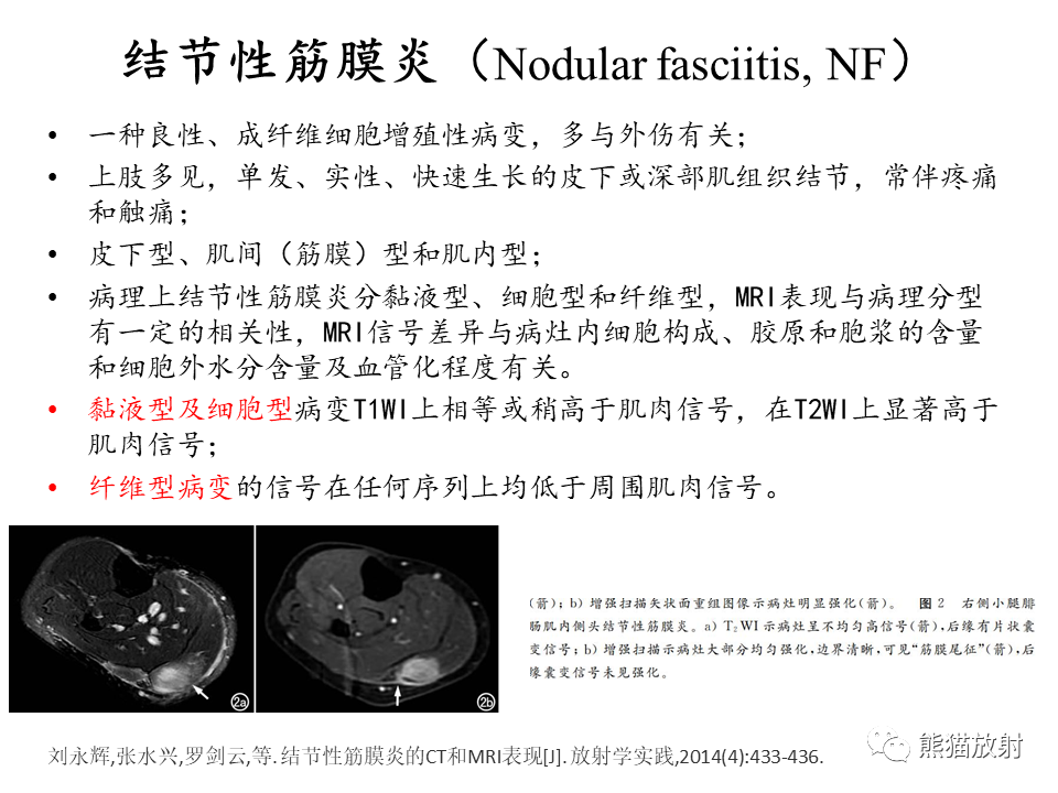 影像PPT - 【病例】腱鞘巨细胞瘤2例MR影像-28