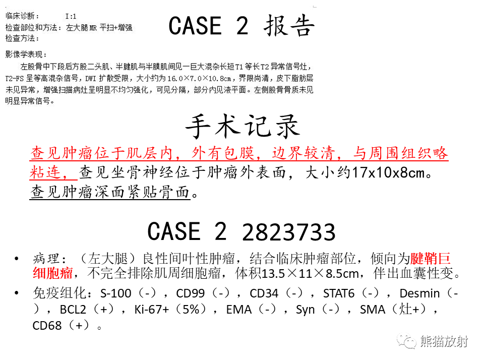 影像PPT - 【病例】腱鞘巨细胞瘤2例MR影像-19