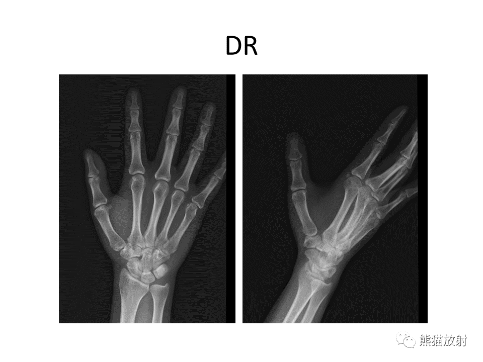 影像PPT - 【病例】腱鞘巨细胞瘤2例MR影像-3