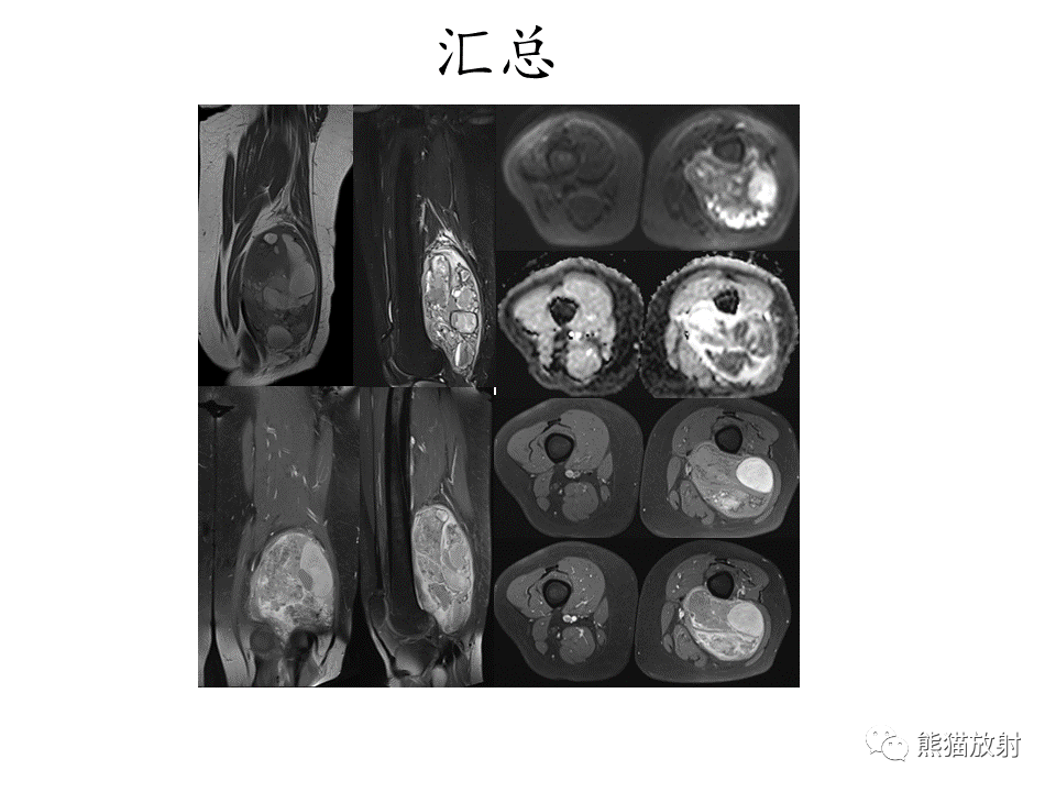 影像PPT - 【病例】腱鞘巨细胞瘤2例MR影像-17