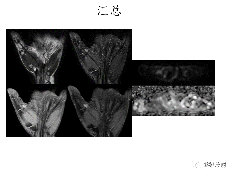 影像PPT - 【病例】腱鞘巨细胞瘤2例MR影像-8