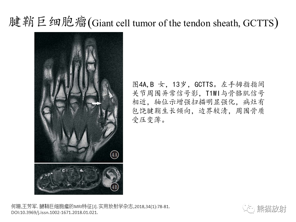 影像PPT - 【病例】腱鞘巨细胞瘤2例MR影像-23