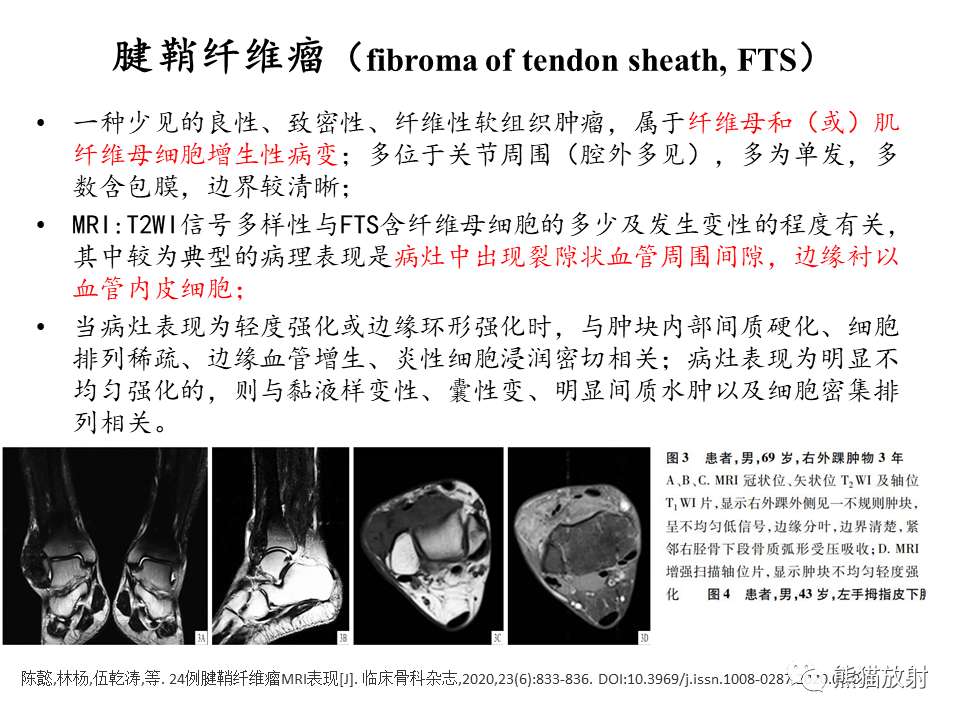 影像PPT - 【病例】腱鞘巨细胞瘤2例MR影像-24