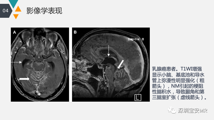 影像PPT - 【PPT】肿瘤性脑膜炎和副肿瘤综合征-13