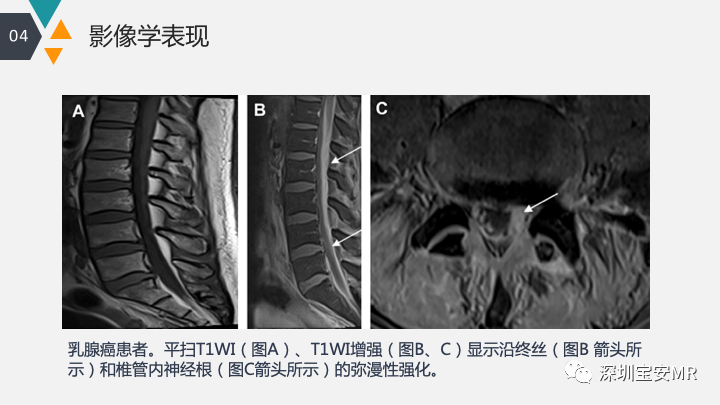 影像PPT - 【PPT】肿瘤性脑膜炎和副肿瘤综合征-14