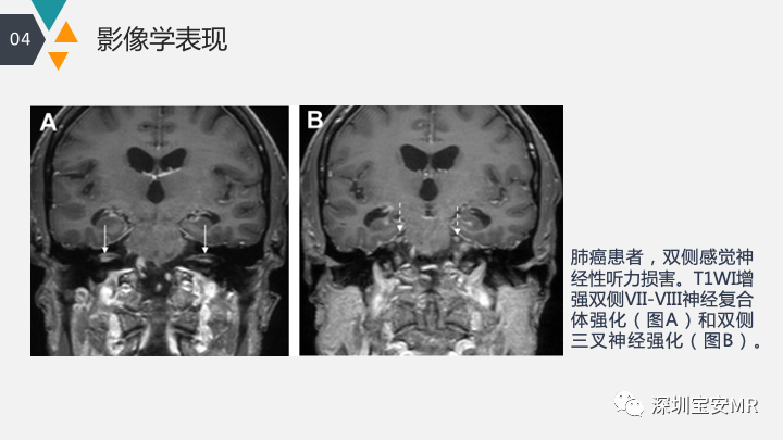 影像PPT - 【PPT】肿瘤性脑膜炎和副肿瘤综合征-12