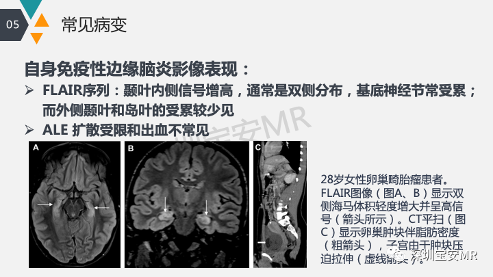影像PPT - 【PPT】肿瘤性脑膜炎和副肿瘤综合征-25