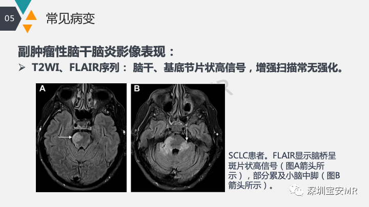 影像PPT - 【PPT】肿瘤性脑膜炎和副肿瘤综合征-28