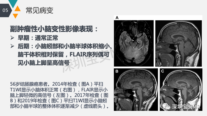 影像PPT - 【PPT】肿瘤性脑膜炎和副肿瘤综合征-23