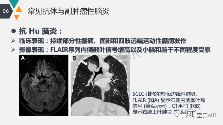影像PPT - 【PPT】肿瘤性脑膜炎和副肿瘤综合征-33