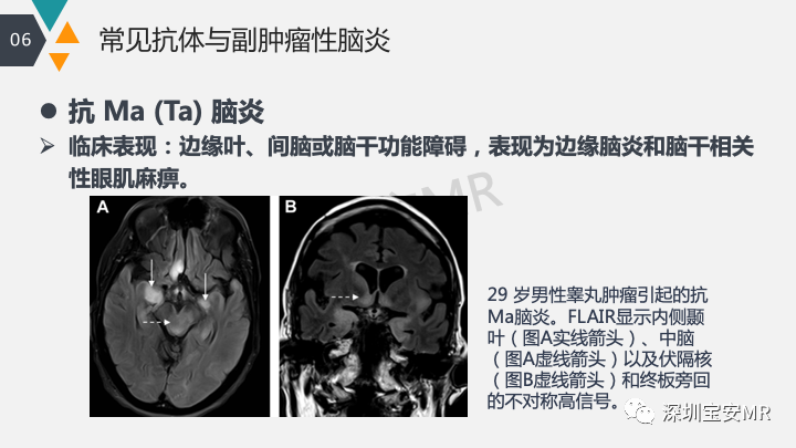 影像PPT - 【PPT】肿瘤性脑膜炎和副肿瘤综合征-34