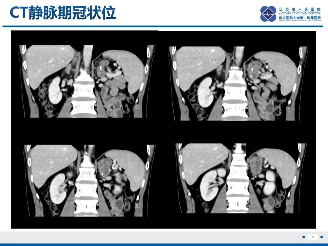 影像PPT - 【PPT】原发性肾上腺皮质功能减退症-7