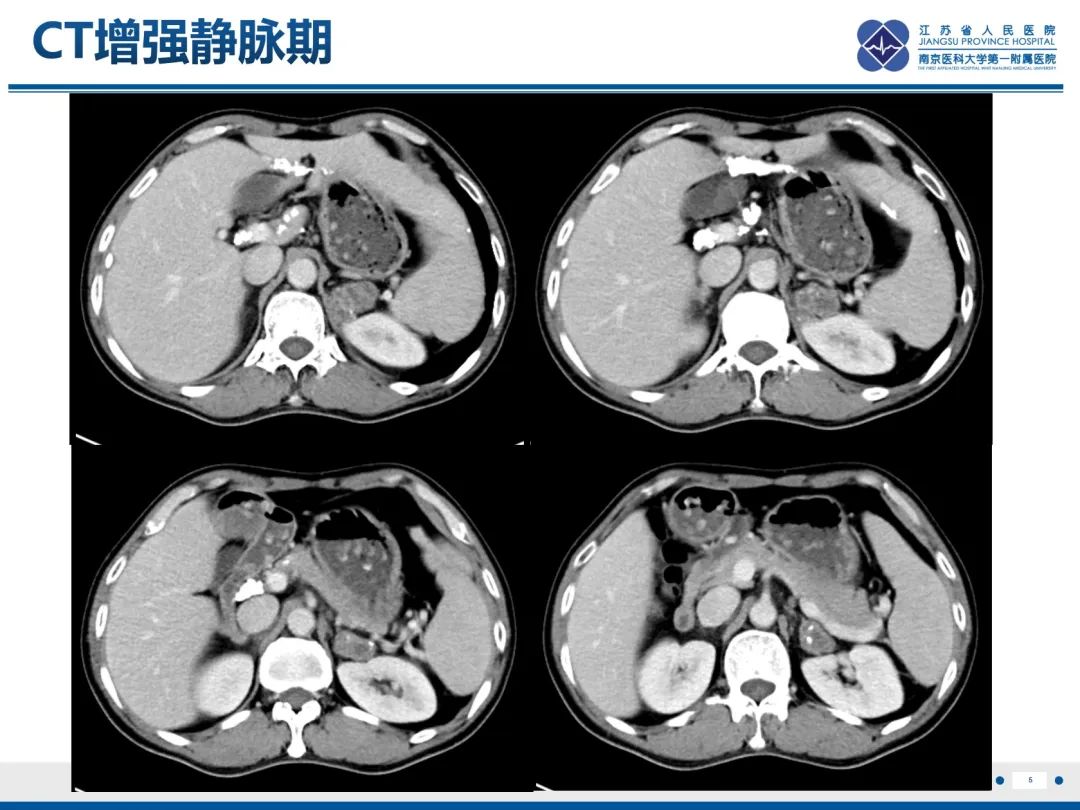 影像PPT - 【PPT】原发性肾上腺皮质功能减退症-6