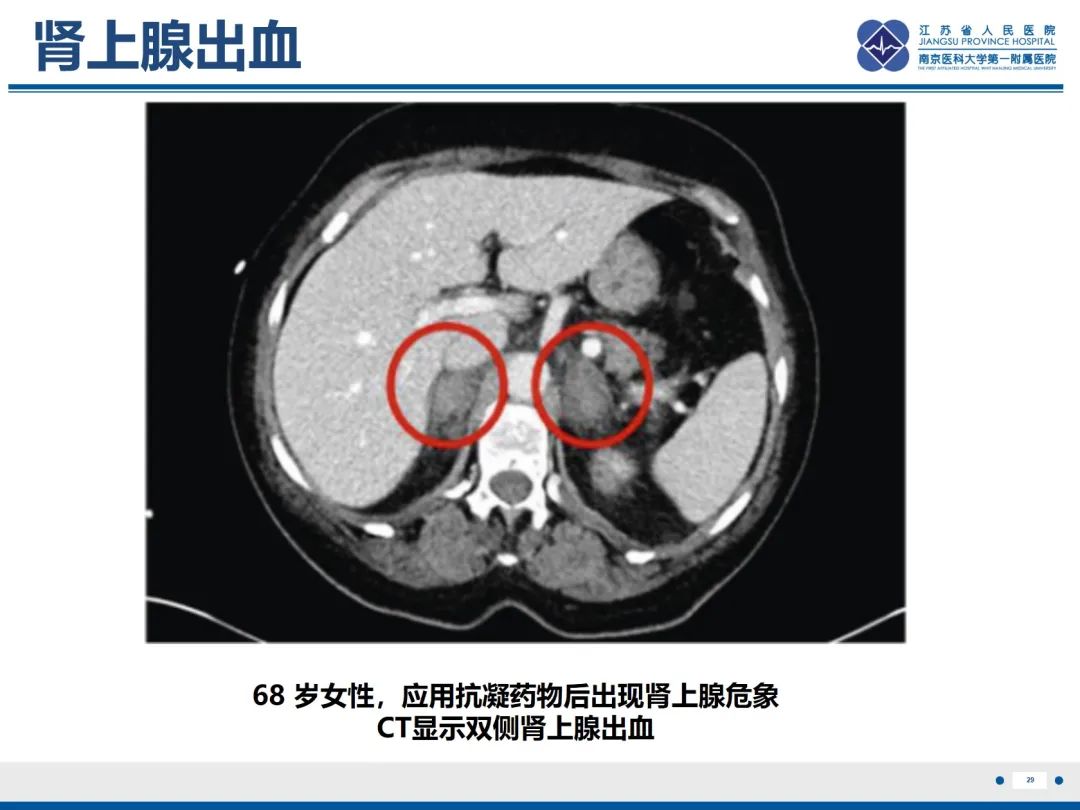 影像PPT - 【PPT】原发性肾上腺皮质功能减退症-30