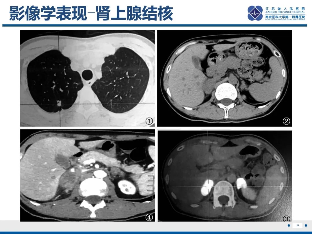影像PPT - 【PPT】原发性肾上腺皮质功能减退症-29