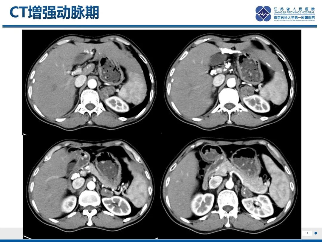 影像PPT - 【PPT】原发性肾上腺皮质功能减退症-5
