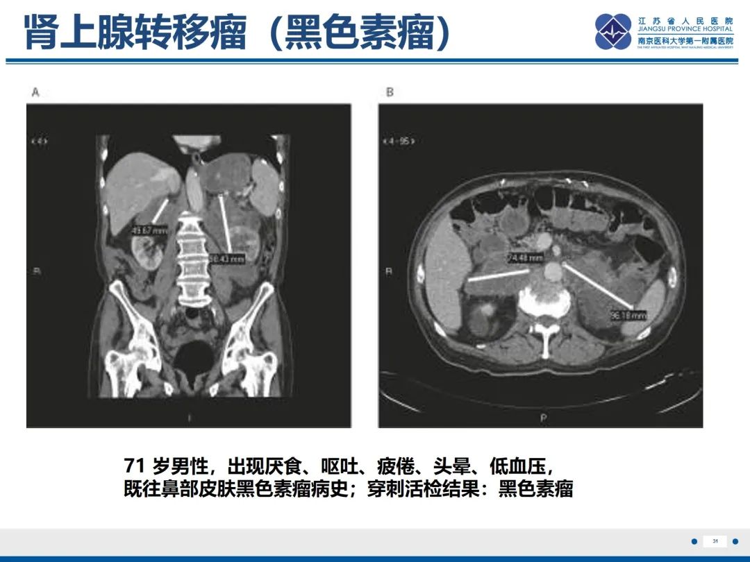 影像PPT - 【PPT】原发性肾上腺皮质功能减退症-32