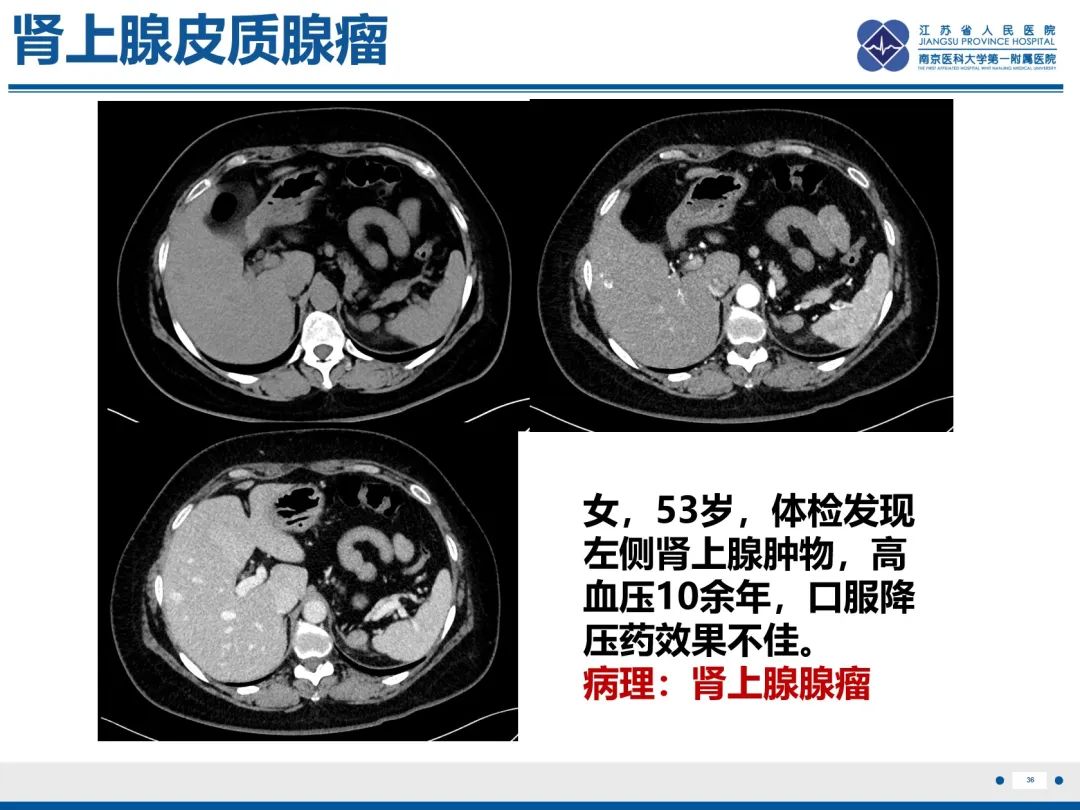 影像PPT - 【PPT】原发性肾上腺皮质功能减退症-37