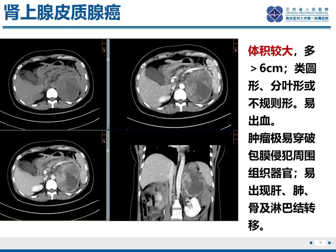 影像PPT - 【PPT】原发性肾上腺皮质功能减退症-38