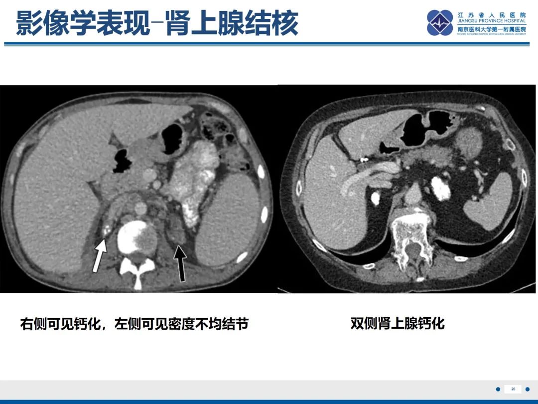影像PPT - 【PPT】原发性肾上腺皮质功能减退症-27