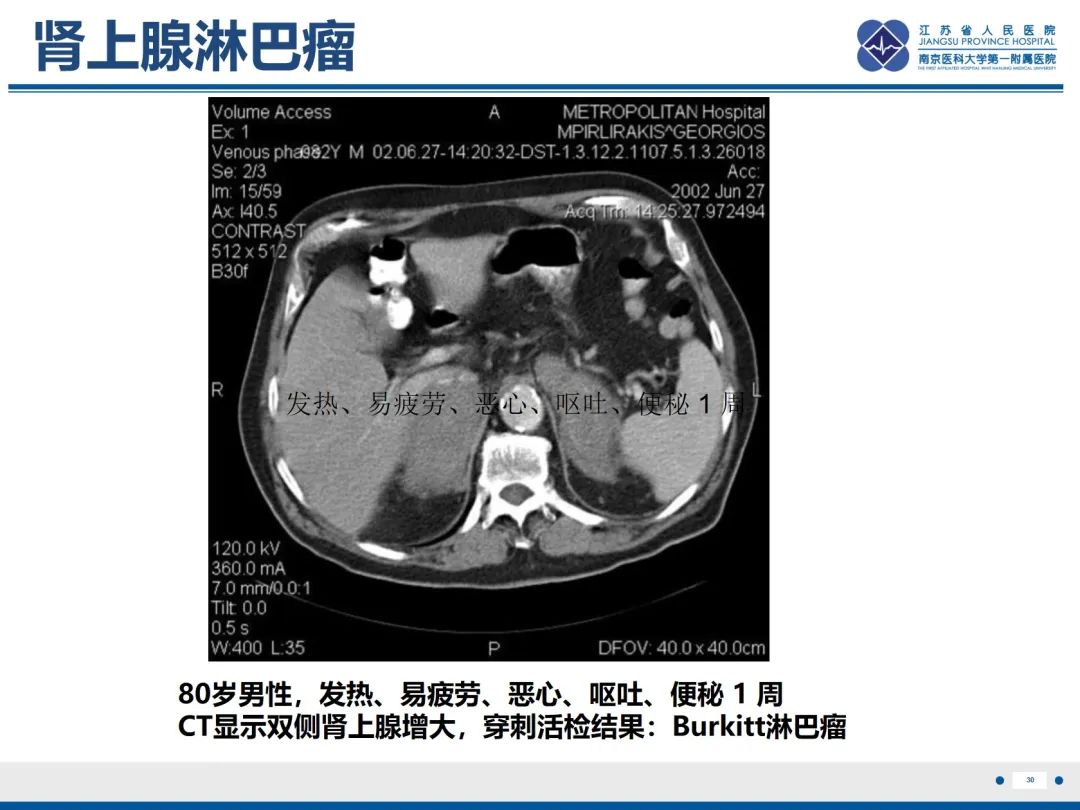 影像PPT - 【PPT】原发性肾上腺皮质功能减退症-31