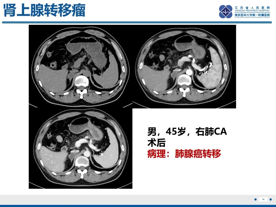 影像PPT - 【PPT】原发性肾上腺皮质功能减退症-35