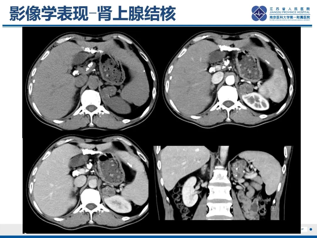 影像PPT - 【PPT】原发性肾上腺皮质功能减退症-28