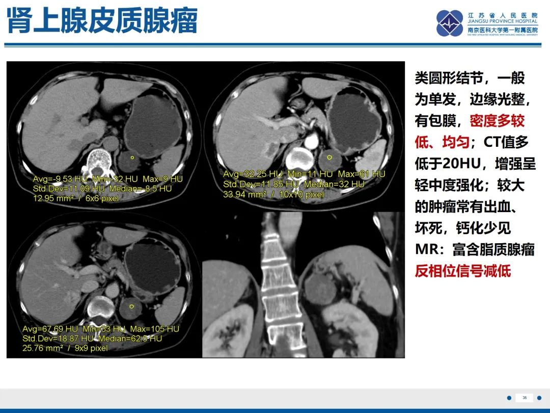 影像PPT - 【PPT】原发性肾上腺皮质功能减退症-36