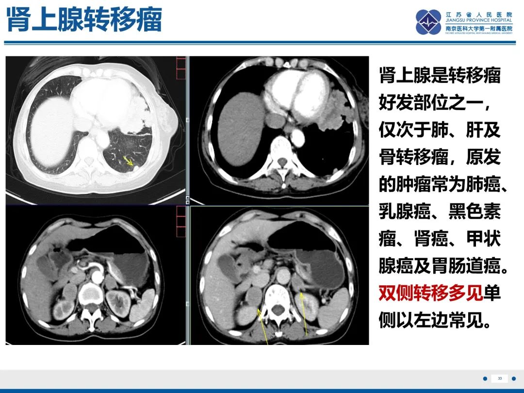 影像PPT - 【PPT】原发性肾上腺皮质功能减退症-34