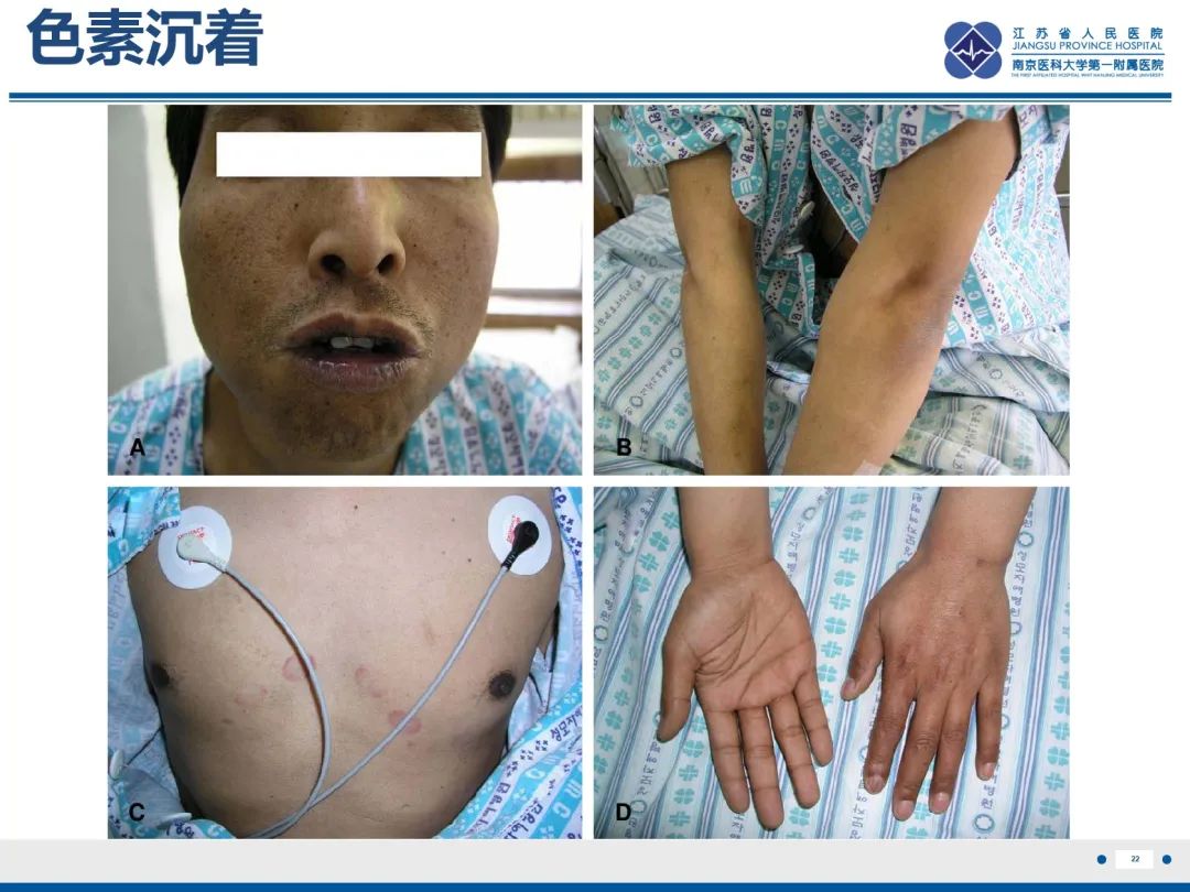 影像PPT - 【PPT】原发性肾上腺皮质功能减退症-2
