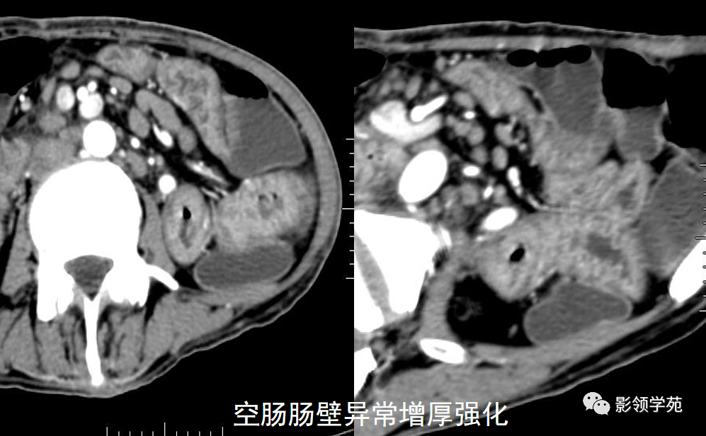 影像PPT - 炎症性肠病CT诊断-8