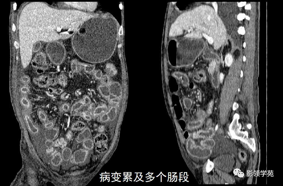 影像PPT - 炎症性肠病CT诊断-6