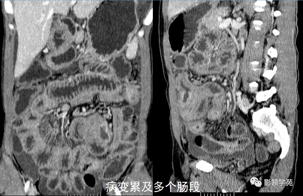 影像PPT - 炎症性肠病CT诊断-7